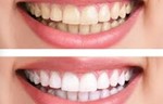 Xtreme Teeth Whitening Tanning Gatwick Xtreme Teeth Whitening result;