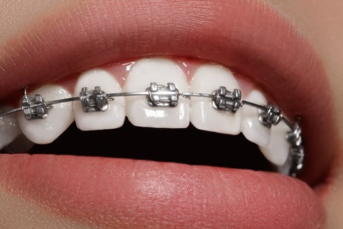 How much do braces cost in 2024?