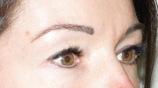 before eyelid reduction