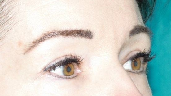 after eyelid reduction