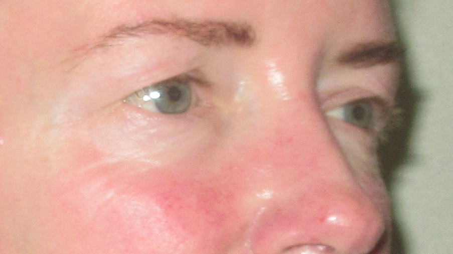 before eyelid reduction