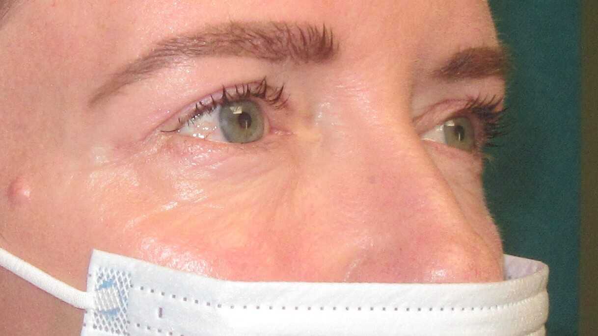 after eyelid reduction