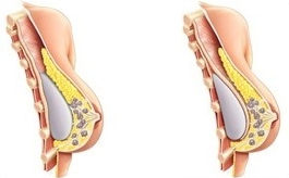 Breast Augmentation Enlargement Hampshire