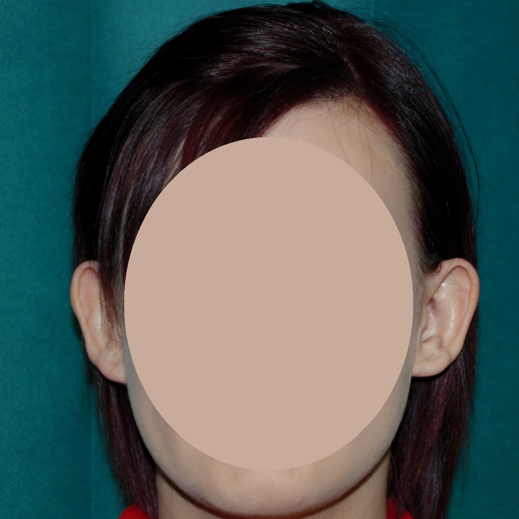 before prominent ear correction