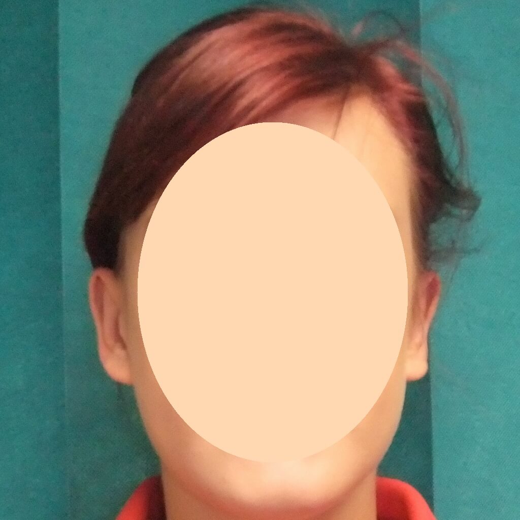 after prominent ear correction