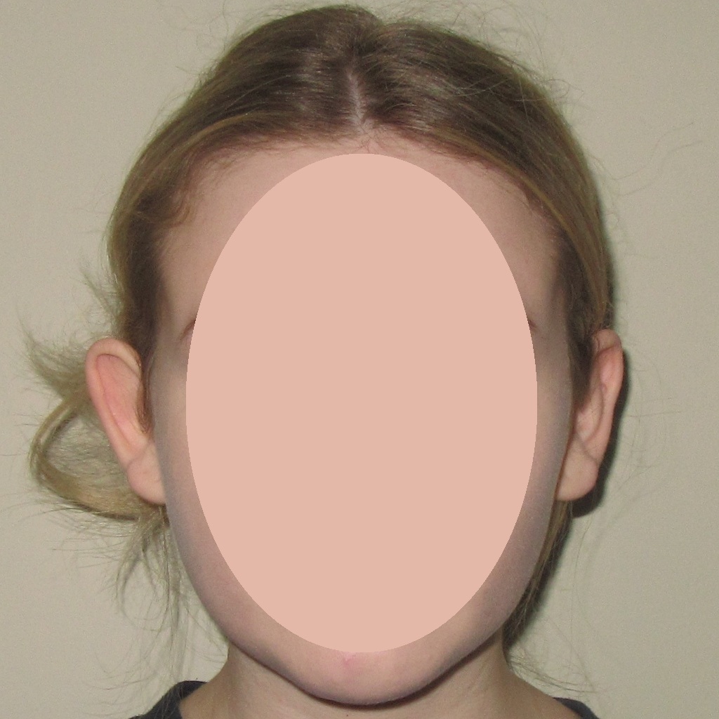 before prominent ear correction
