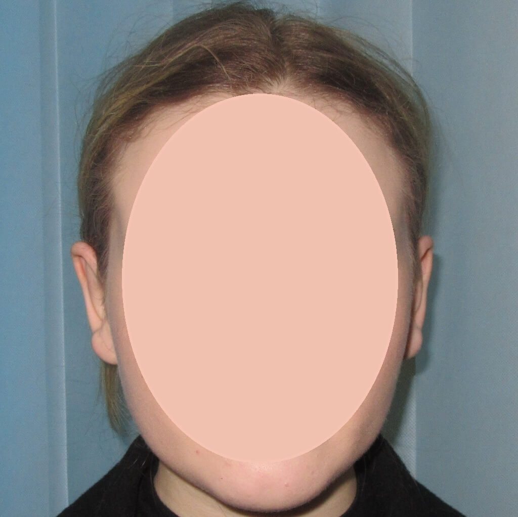 after prominent ear correction