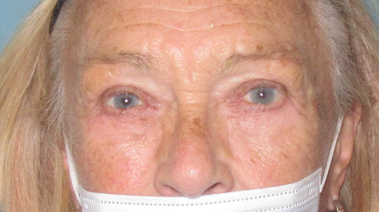 after blepharoplasty (eyelid reduction)