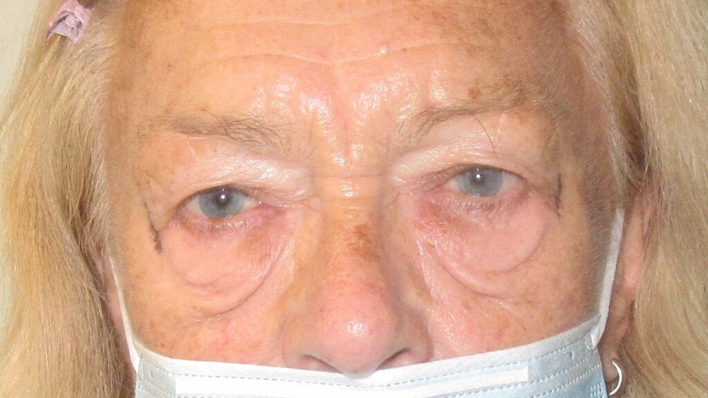 before blepharoplasty (eyelid reduction)