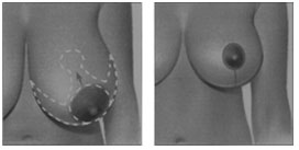 Breast Reduction Mastoplexy Uplift Hampshire