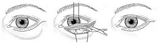 Blepharoplasty Eye Lid Reduction Hampshire