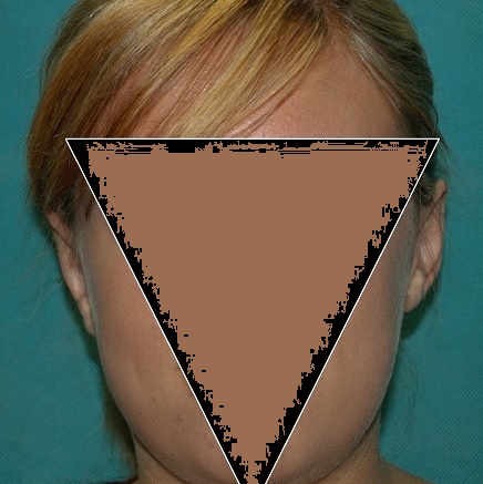 after prominent ear correction