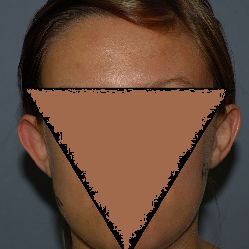 before prominent ear correction