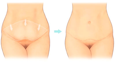 Abdominoplasty Tummy Tuck Hampshire