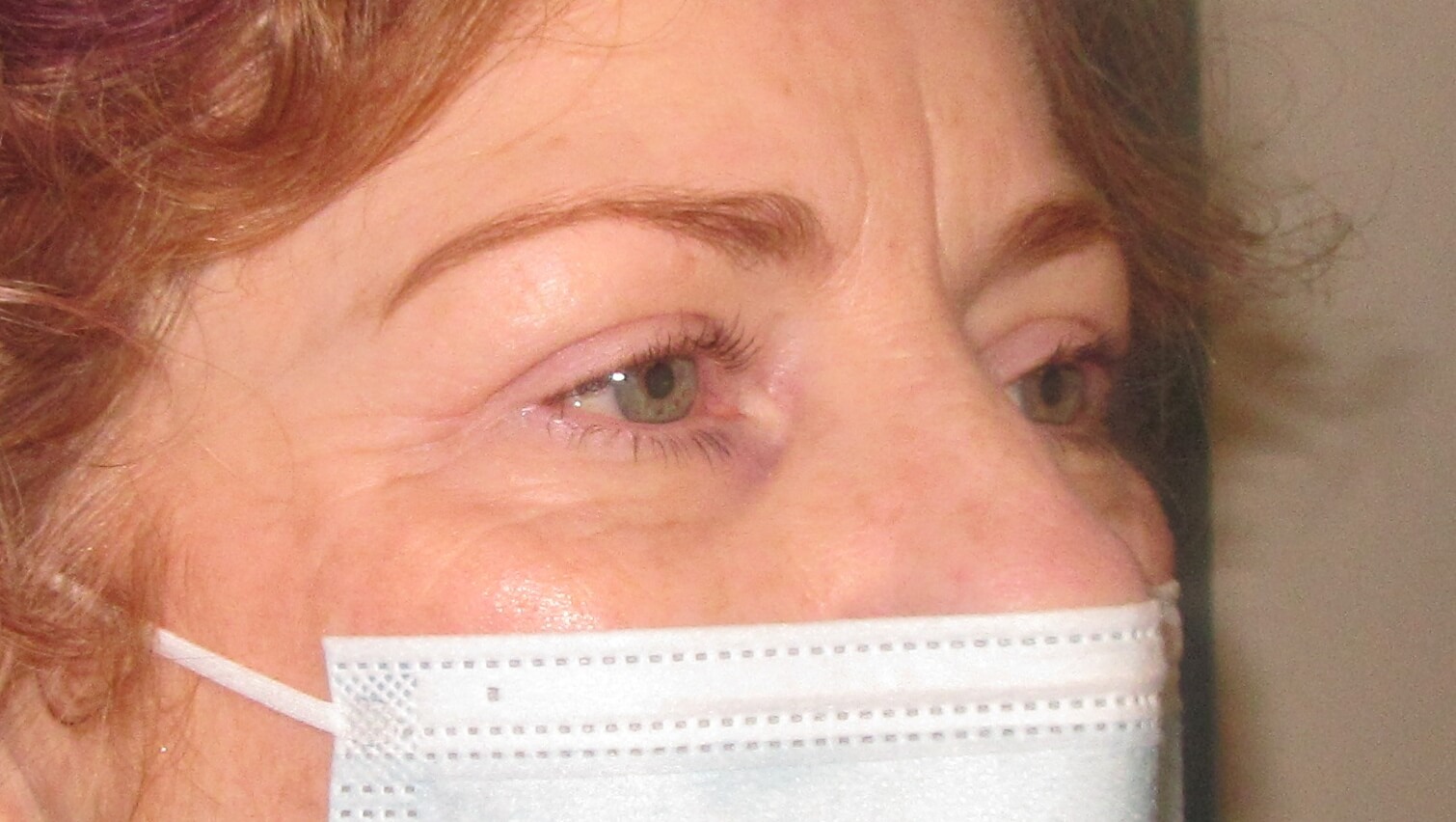 after eyelid reduction