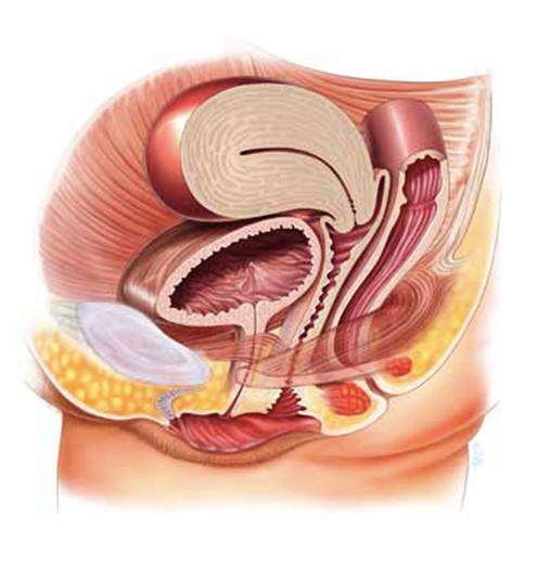 bladder prolapse sling