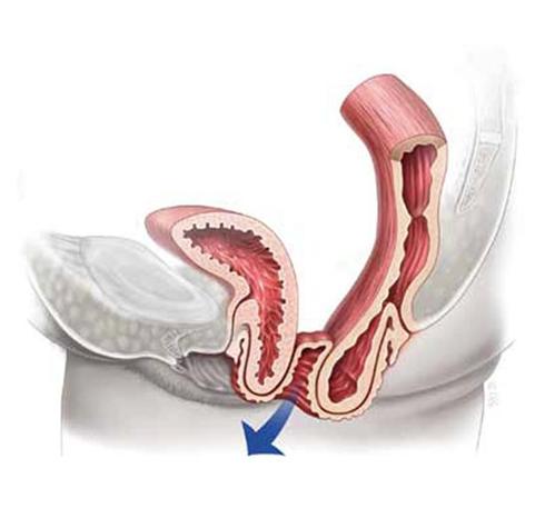 bladder prolapse sling