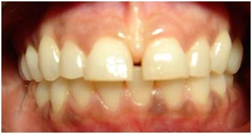 Clear Braces in West London