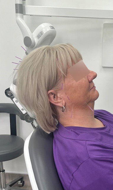 Bruxism img