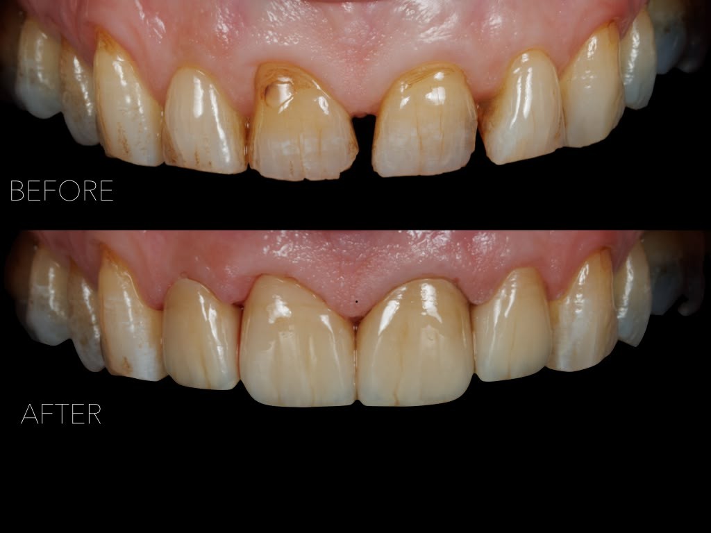 before after