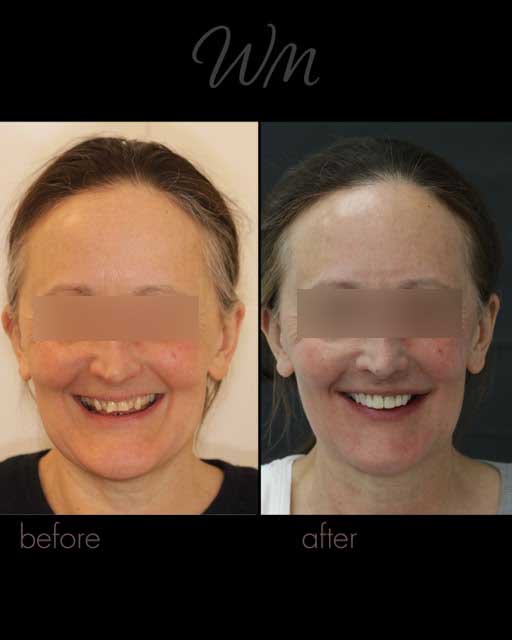 before after10