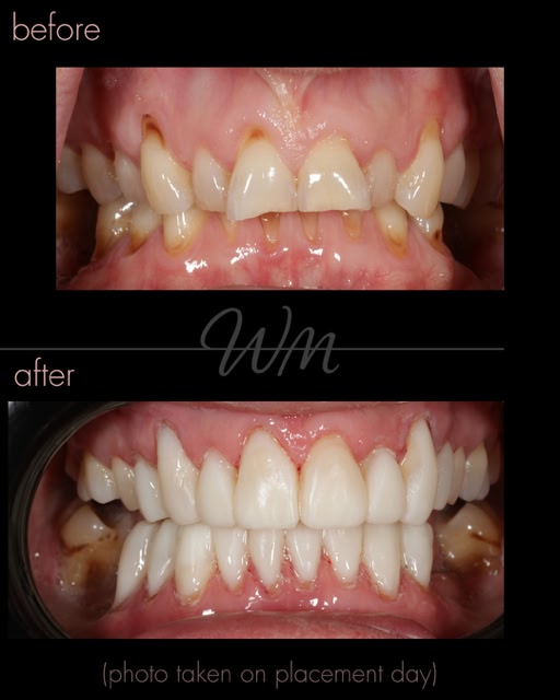 before after11