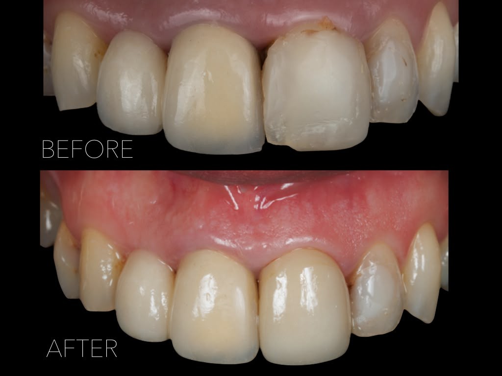 before after3