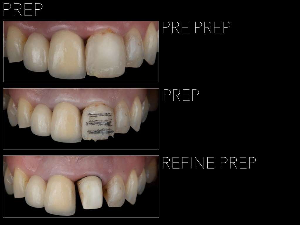 before after7