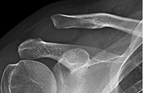 This is a chronic grade 3 ACJ separation. You can see the end of the clavicle is lifted up away from the acromion.