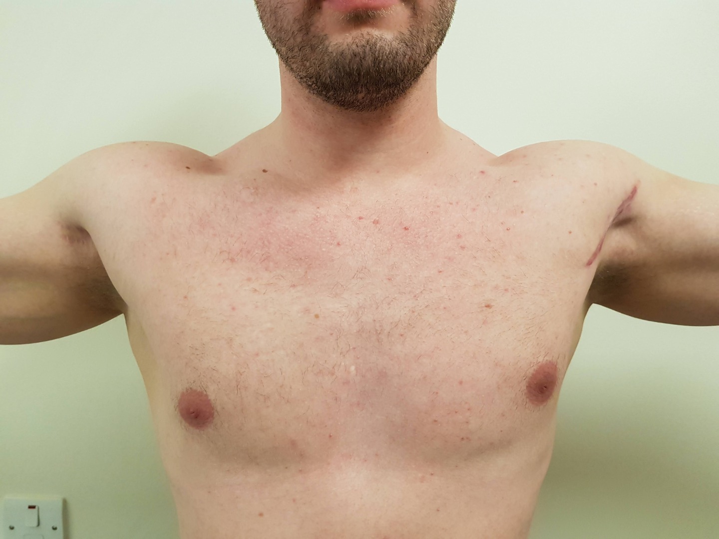 pec-major-tendon-tears-the-shoulder-and-elbow-clinic