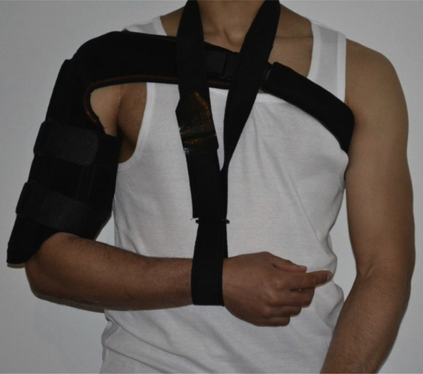 hanging arm cast for humerus fracture