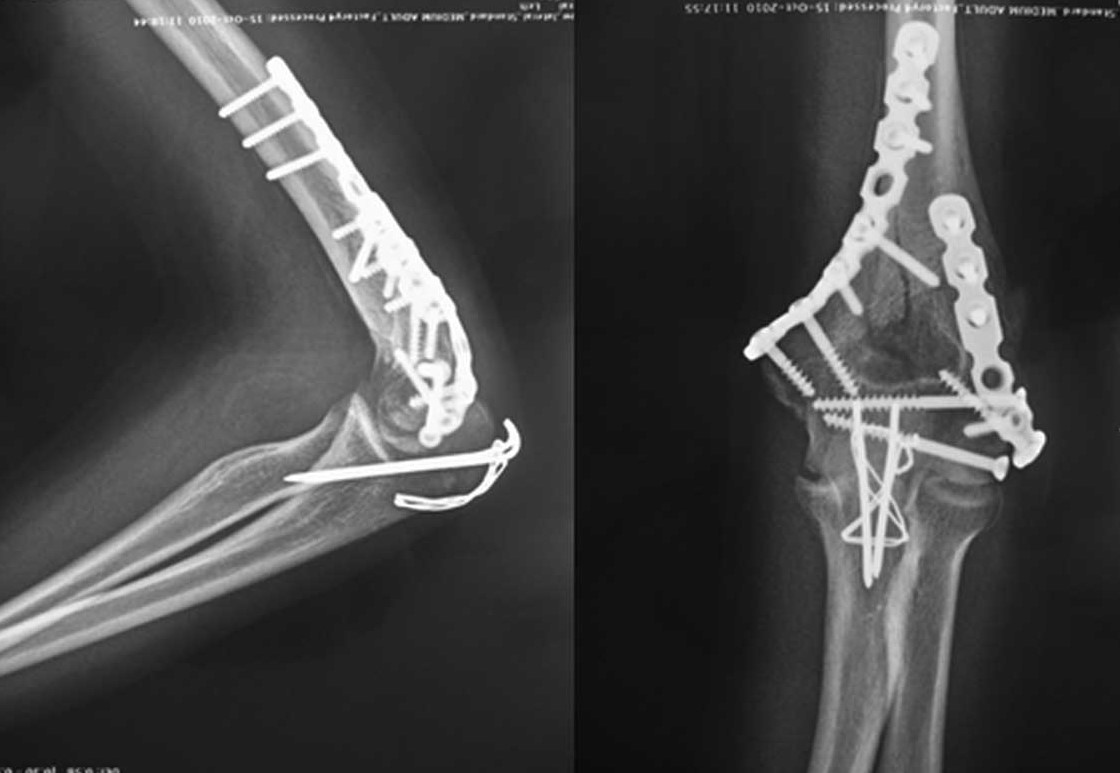 supracondylar humerus fracture