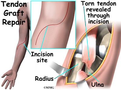 ripped bicep tendon