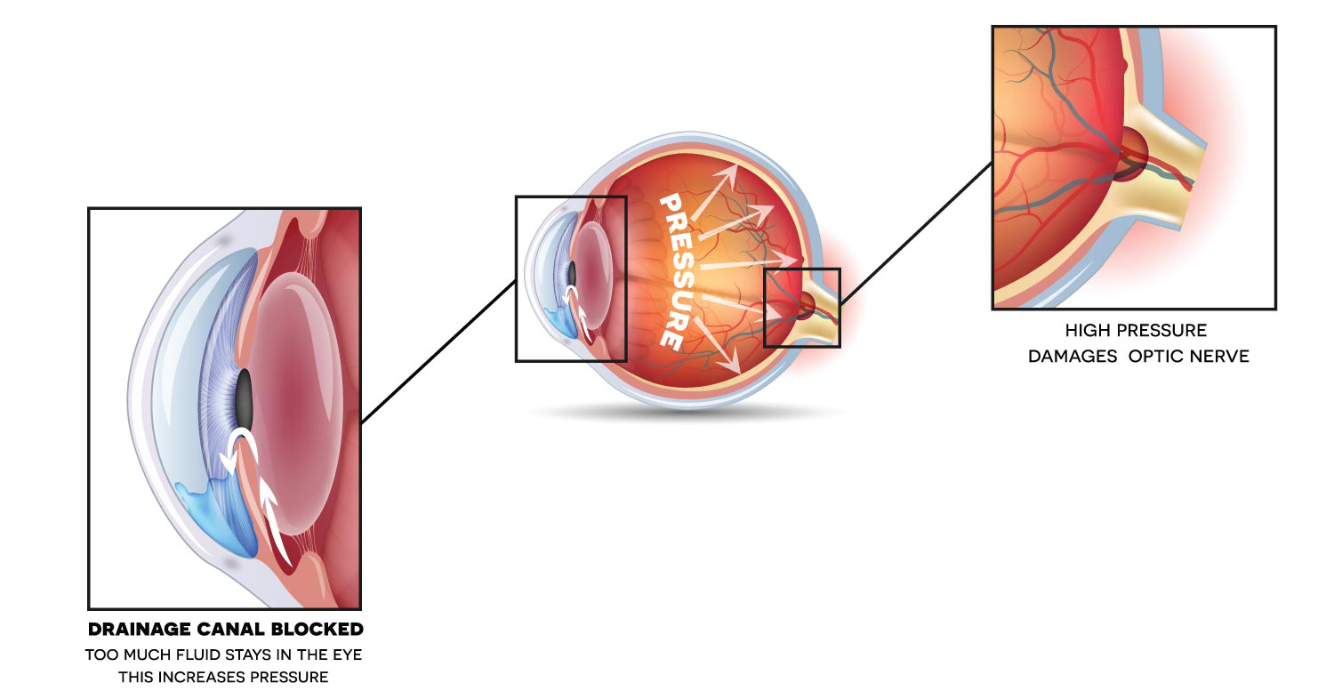 glaucoma hyperopia falusi vízió