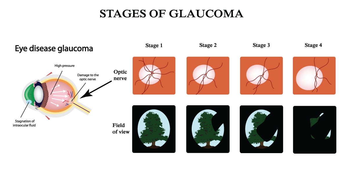 glaucoma hyperopia)