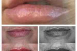 This Client came in to us after previously being injected with filler without consideration of her natural lip anatomy. The client was left with over filled, unsymmetrical, lumpy lips!
Dr Jeremy Isaac used 0.5ml to balance and correct. Work in progress!