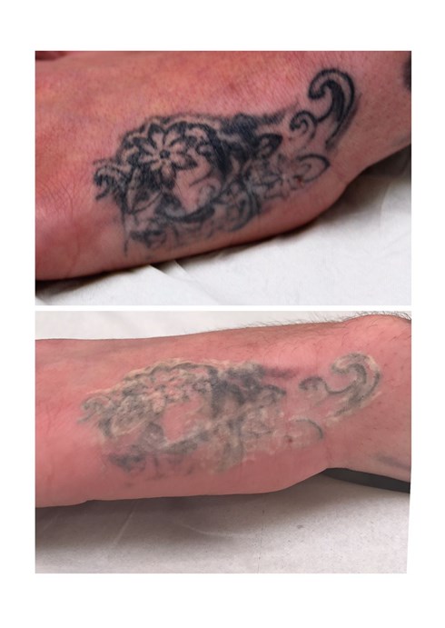 Before and after 1 treatment