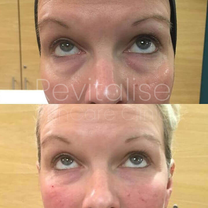 Hollow Under Eye Treatment (Tear Trough) : Revitalise Skin Care Clinic