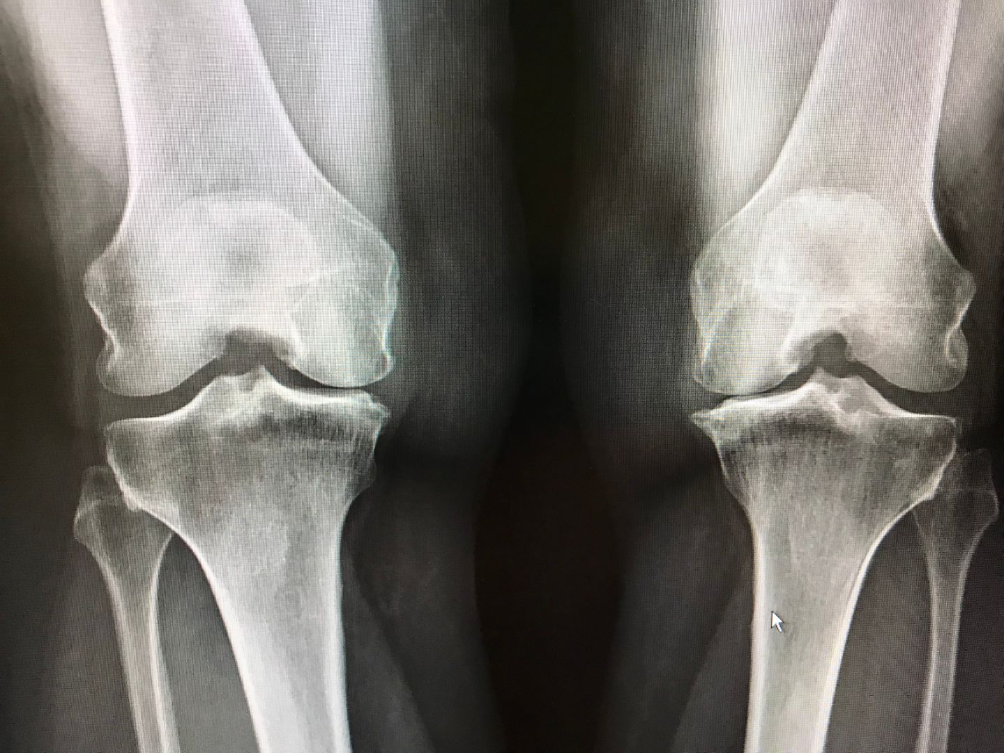 knee joint x ray