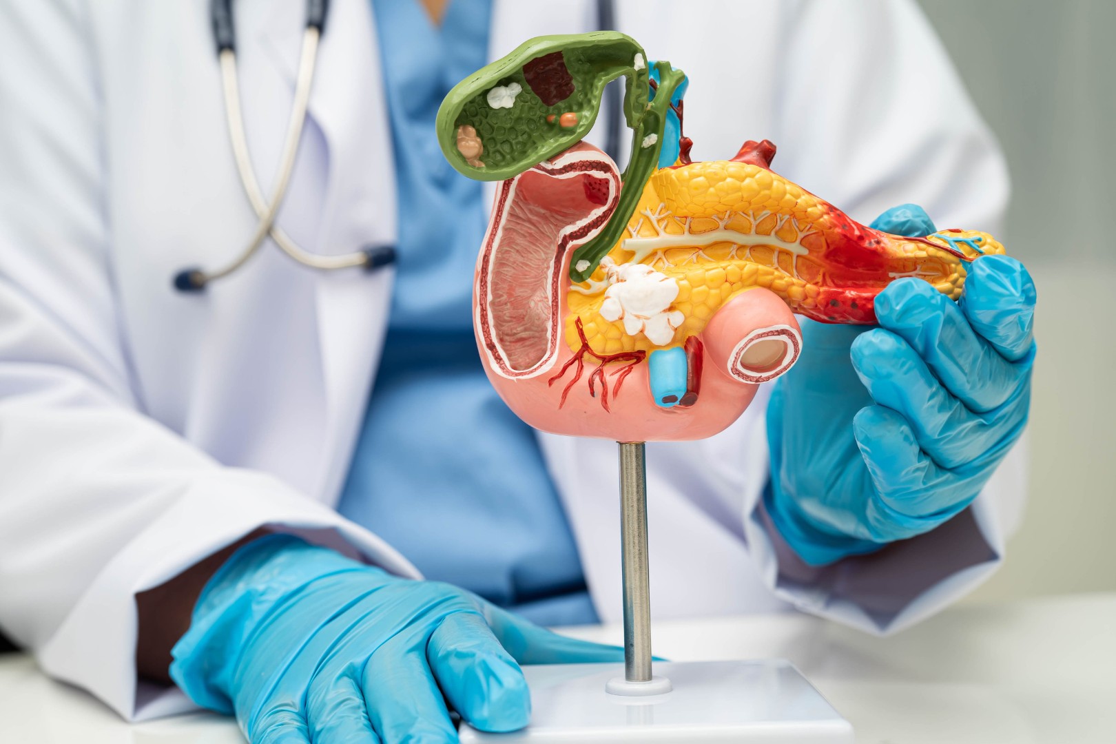 Pancreatic cancer