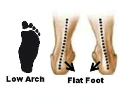 Flat feet diagram