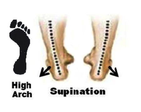 Supinated feet diagram
