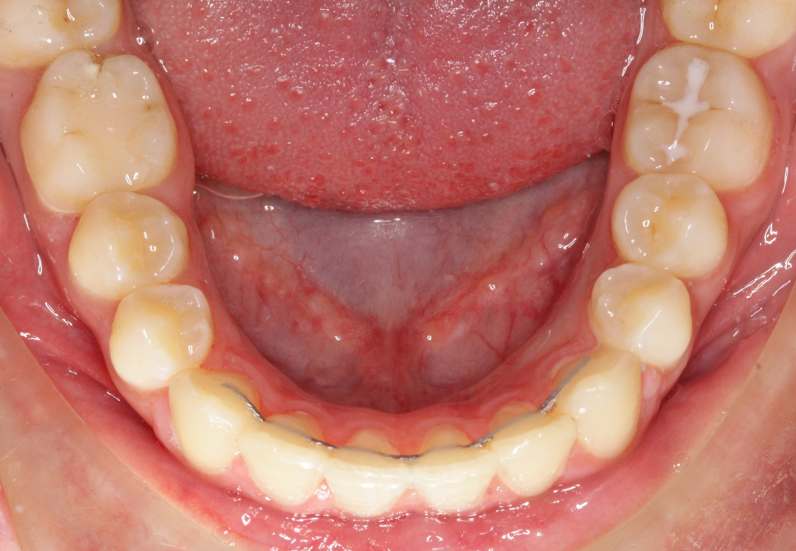 Lingual Braces