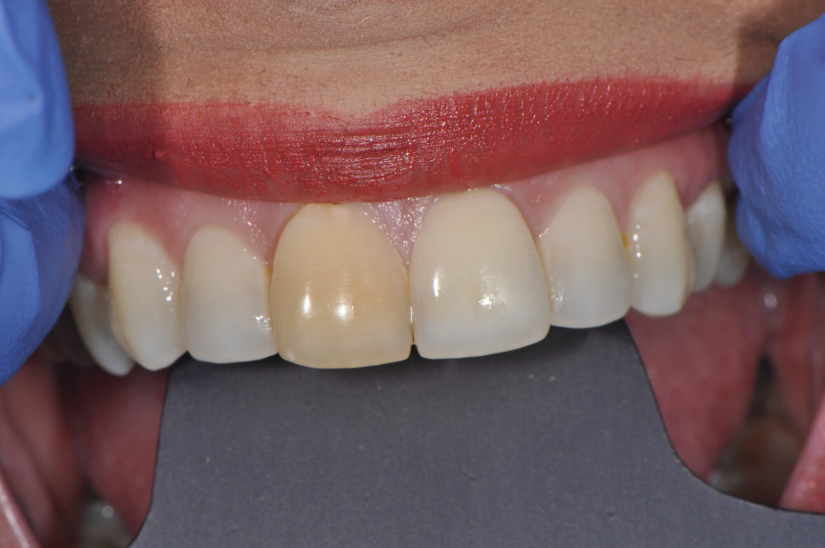 Image of Teeth Whitening, Female