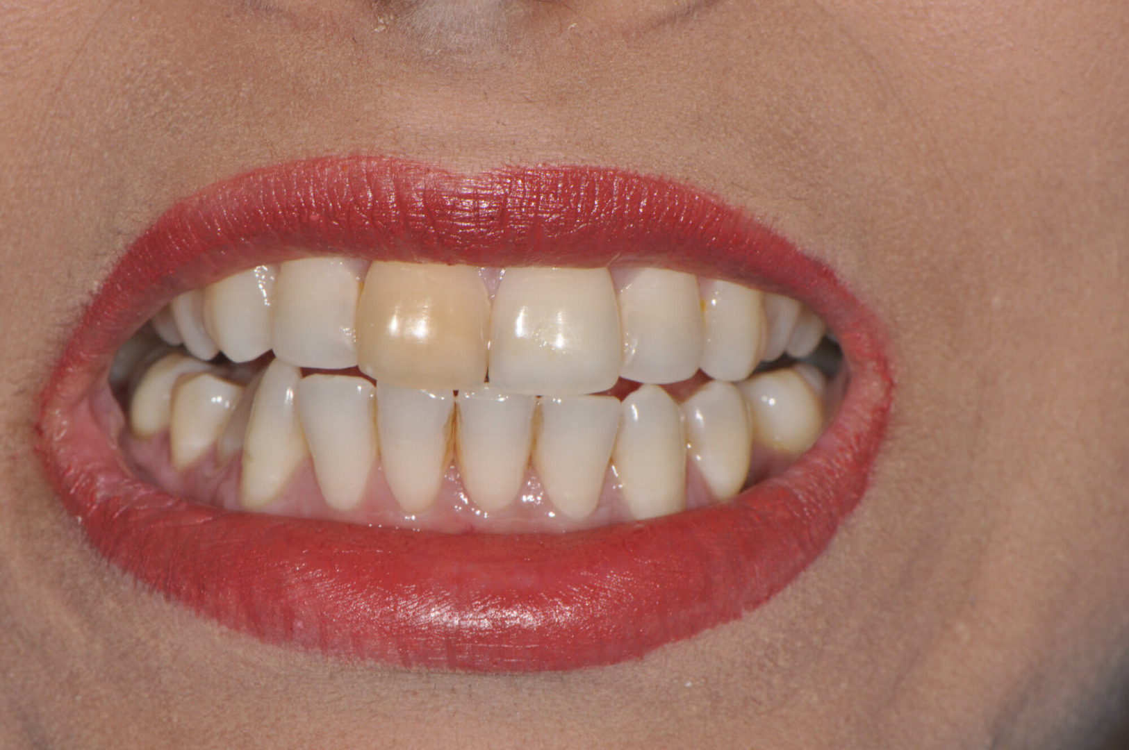 Image of Teeth Whitening, Female