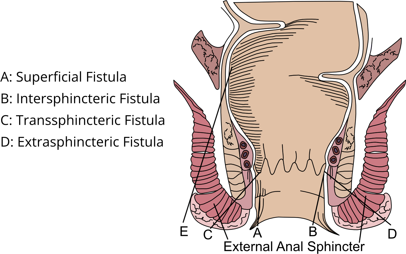 anal fistular