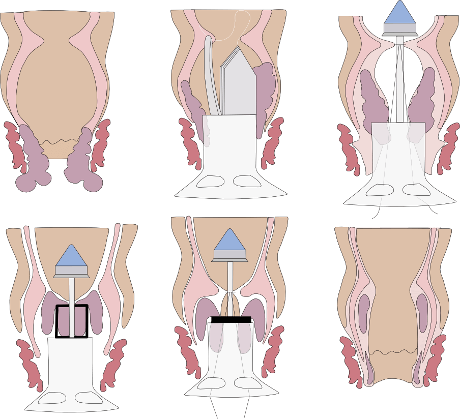 stapled haemorrhoidectomy