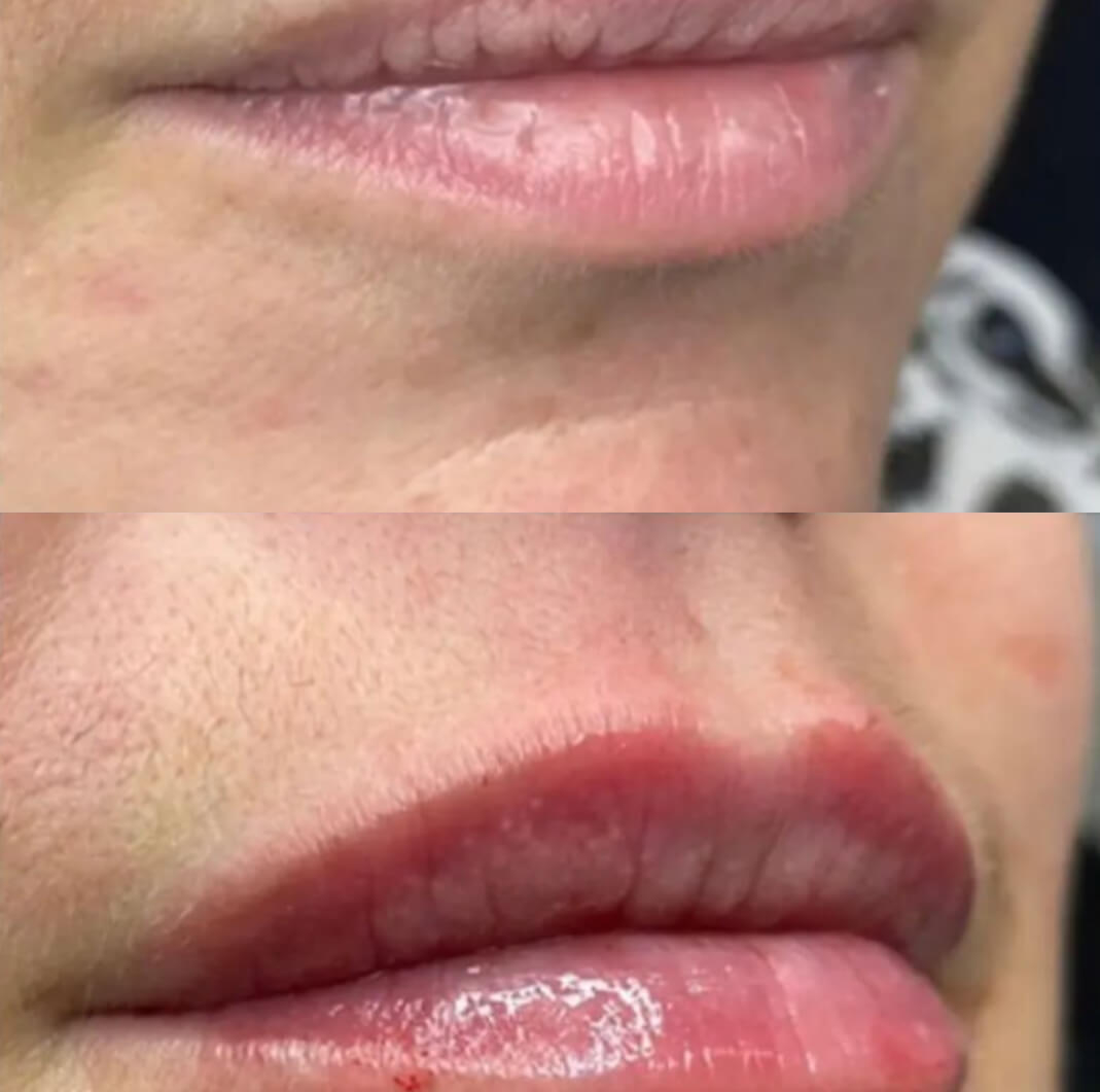 lip before after