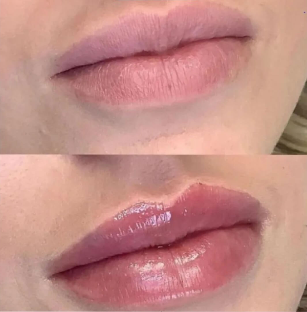 lips before after
